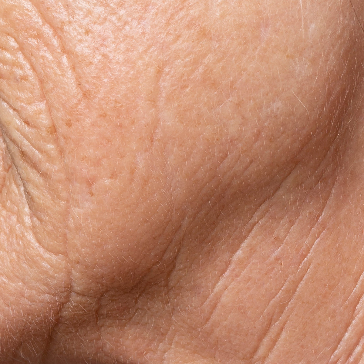 Ageing, Sagging Skin And Volume Loss
