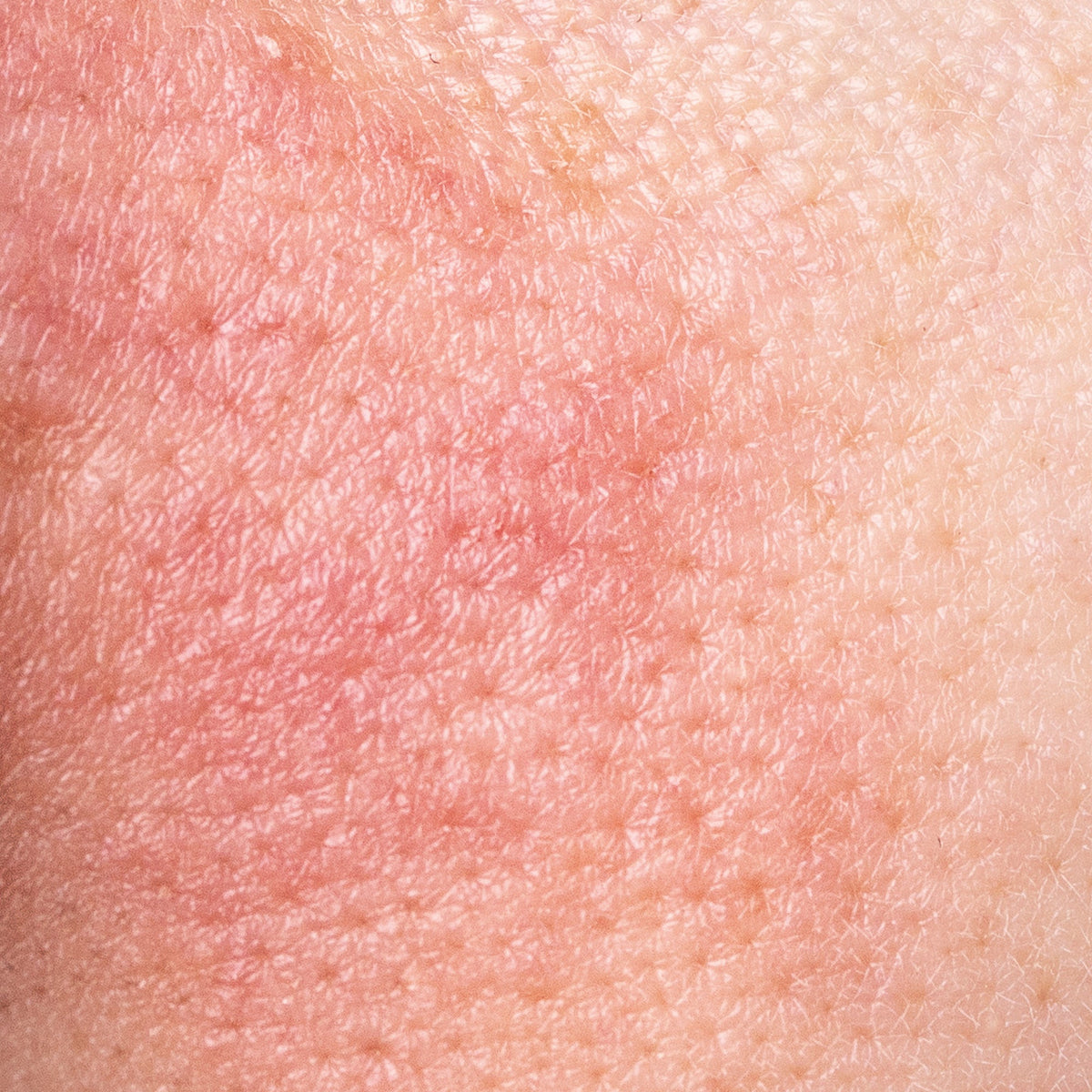 Reactive, Imbalanced And Irritated Skin