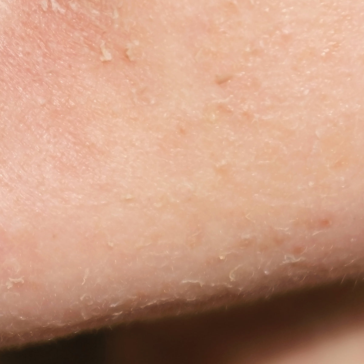 Flaky Skin